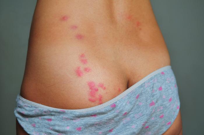 What do Bed Bug Bites Look Like