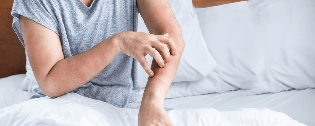 What Should You Do If You Stayed At A Hotel With Bed Bugs?