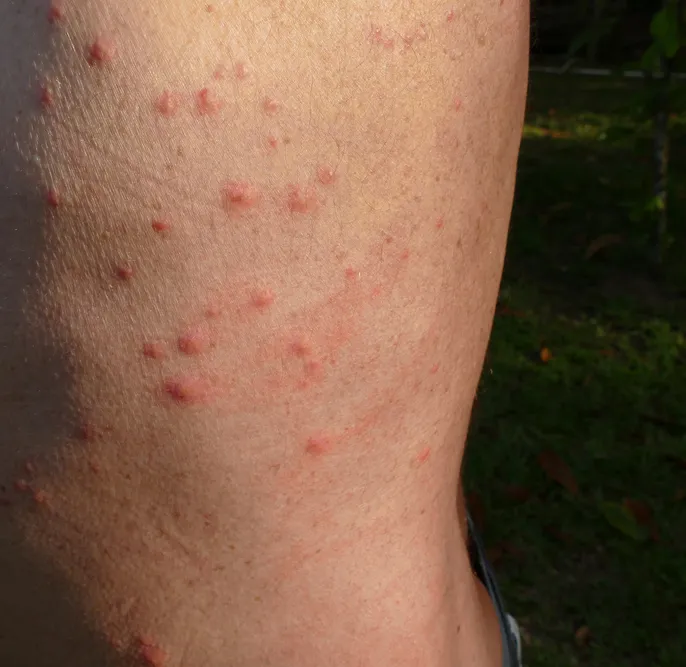 Beg Bug bites